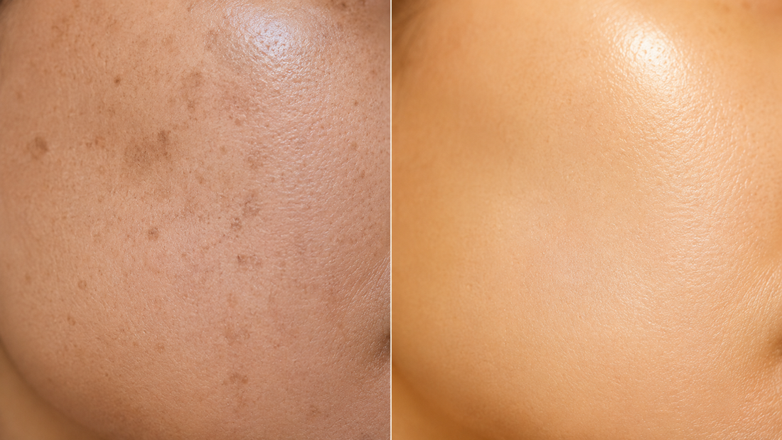 Dark Spots, Melasma, and the Prescription Most Dermatologists Reach For First — And Why Some Patients Are Looking for Something Different