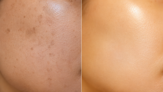 Dark Spots, Melasma, and the Prescription Most Dermatologists Reach For First — And Why Some Patients Are Looking for Something Different